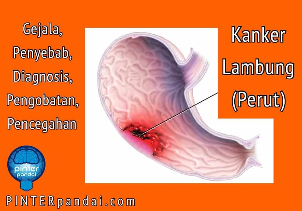 Kanker lambung perut