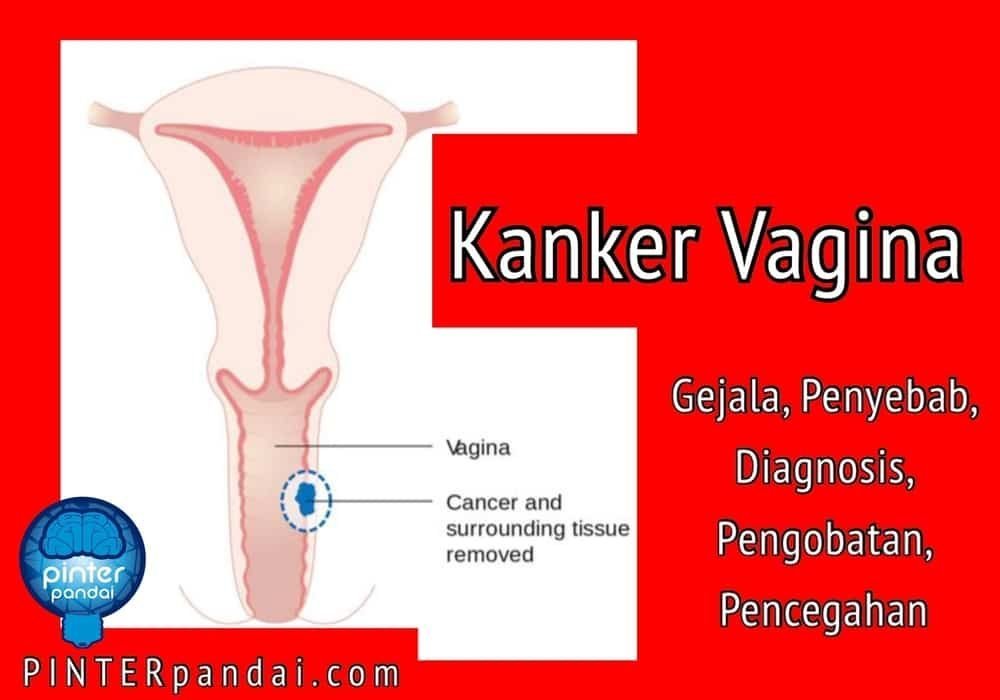 Kanker vagina