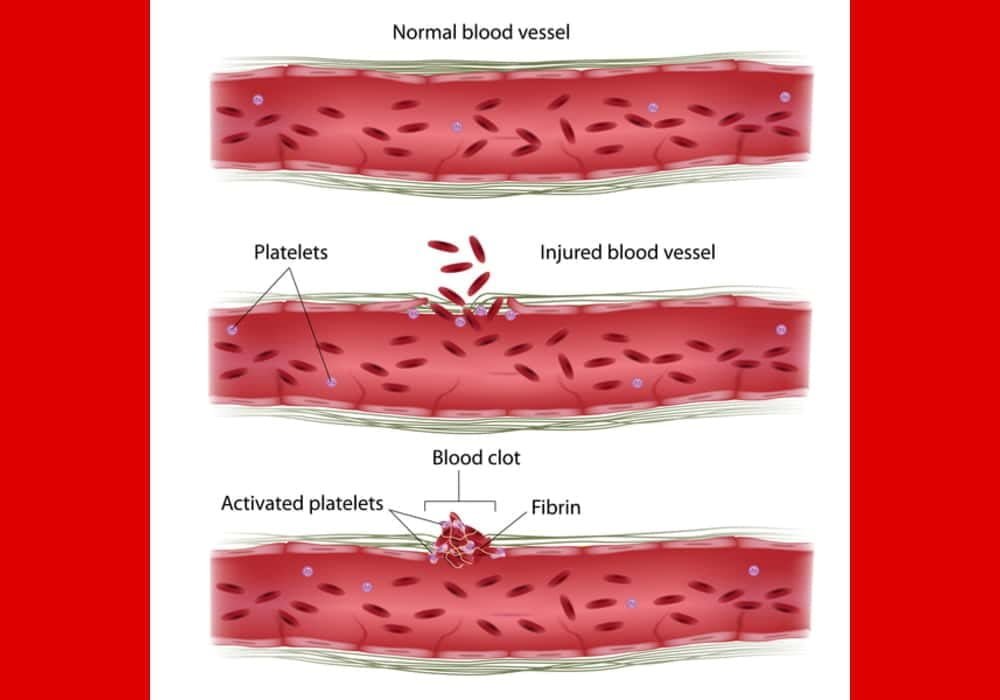 Bernard soulier syndrome pembekuan darah