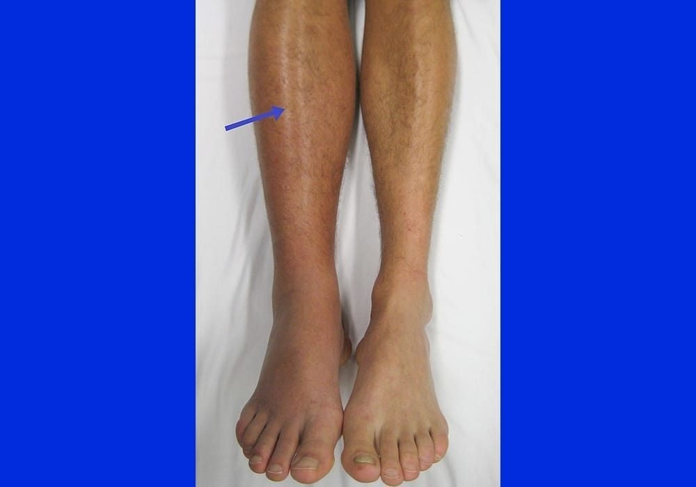 Jumlah trombosit normal