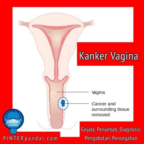 Kanker vagina