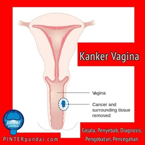 Kanker vagina