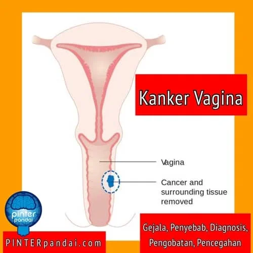 Kanker vagina