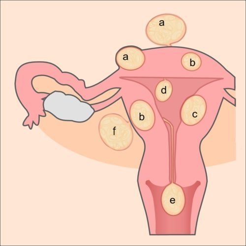 Jenis dan letak miom: a = fibroid subserosa b = fibroid intramural c = fibroid submukosa d = fibroid submukosa bertangkai e = fibroid di patung nascendi f = fibroid intraligamental