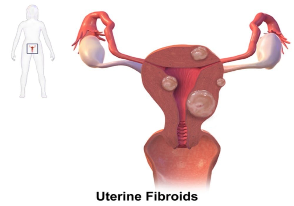 Miom (Uterine fibroid) - Penyebab, Jenis, Gejala, Diagnosa, Perawatan, Pengobatan
