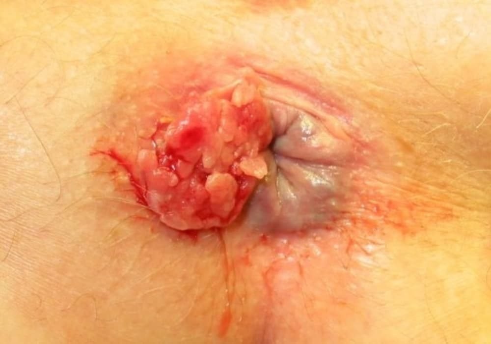Kanker Anus (Dubur) - Tanda Gejala, Penyebab, Diagnosis, Pengobatan, Pencegahan