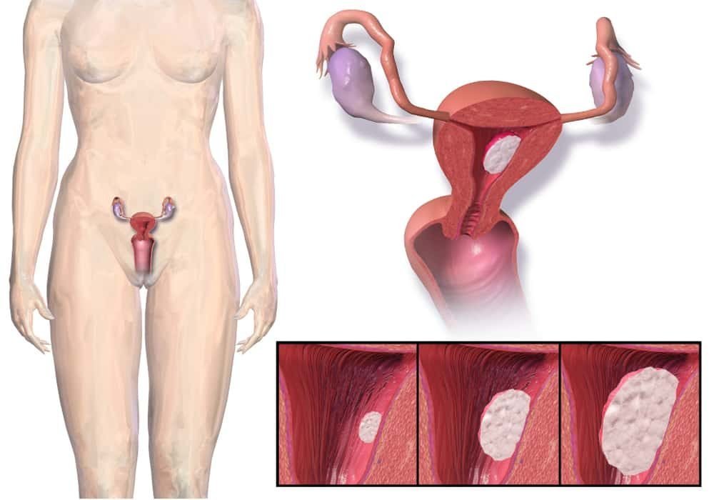 Kanker Endometrium (Lapisan Rahim) - Tanda Gejala, Penyebab, Diagnosis, Pengobatan, Pencegahan