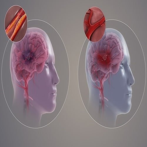 Stroke - Gejala, Diagnosis, Pencegahan, Perawatan dan Pengobatan