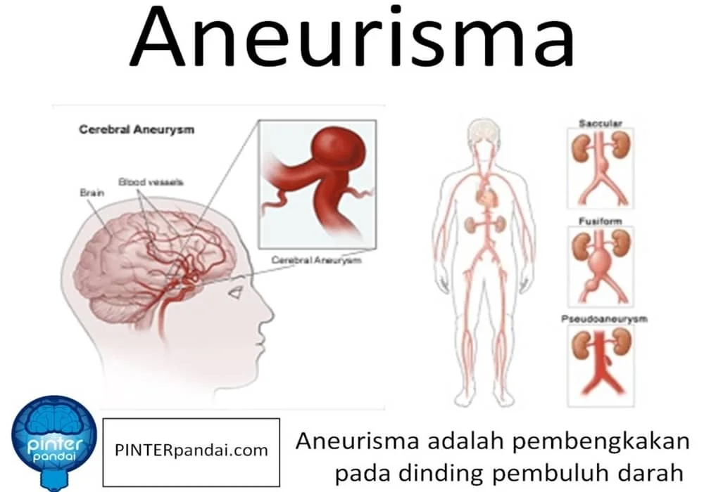 Aneurisma Otak, Perut - Penjelasa, Jenis, Penyebab-Diagnosa, Pencegahan dan Pengobatan