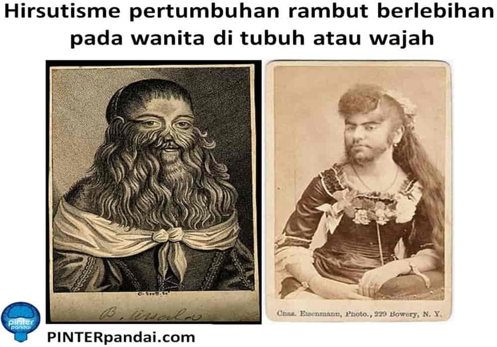 Hirsutisme rambut berlebihan pada wanita