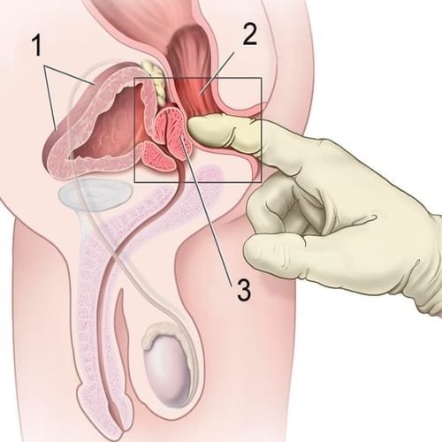 Kanker Rektum (Rektal) - Gejala, Penyebab, Diagnosis, Pengobatan, Pencegahan