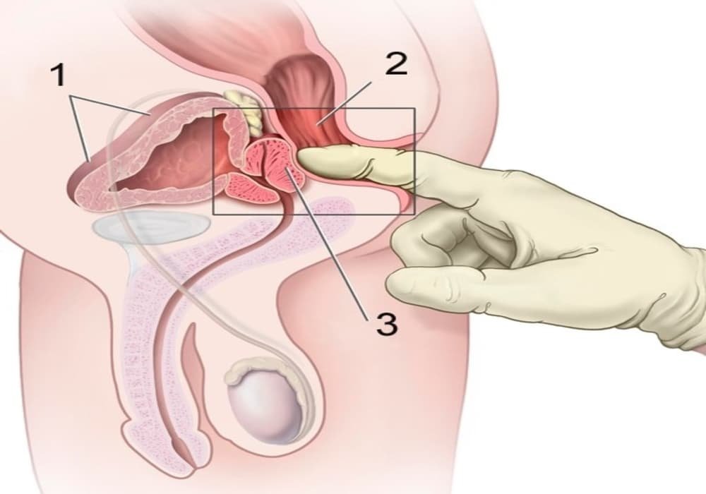 Kanker Rektum (Rektal) - Gejala, Penyebab, Diagnosis, Pengobatan, Pencegahan