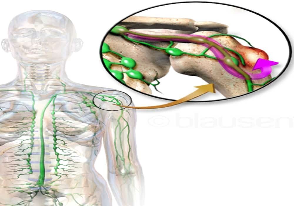 Kanker Tulang (Bone Cancer) - Tanda Gejala, Penyebab, Diagnosis, Pengobatan, Pencegahan
