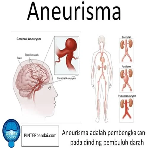 Aneurisma Otak, Perut - Penjelasa, Jenis, Penyebab-Diagnosa, Pencegahan dan Pengobatan