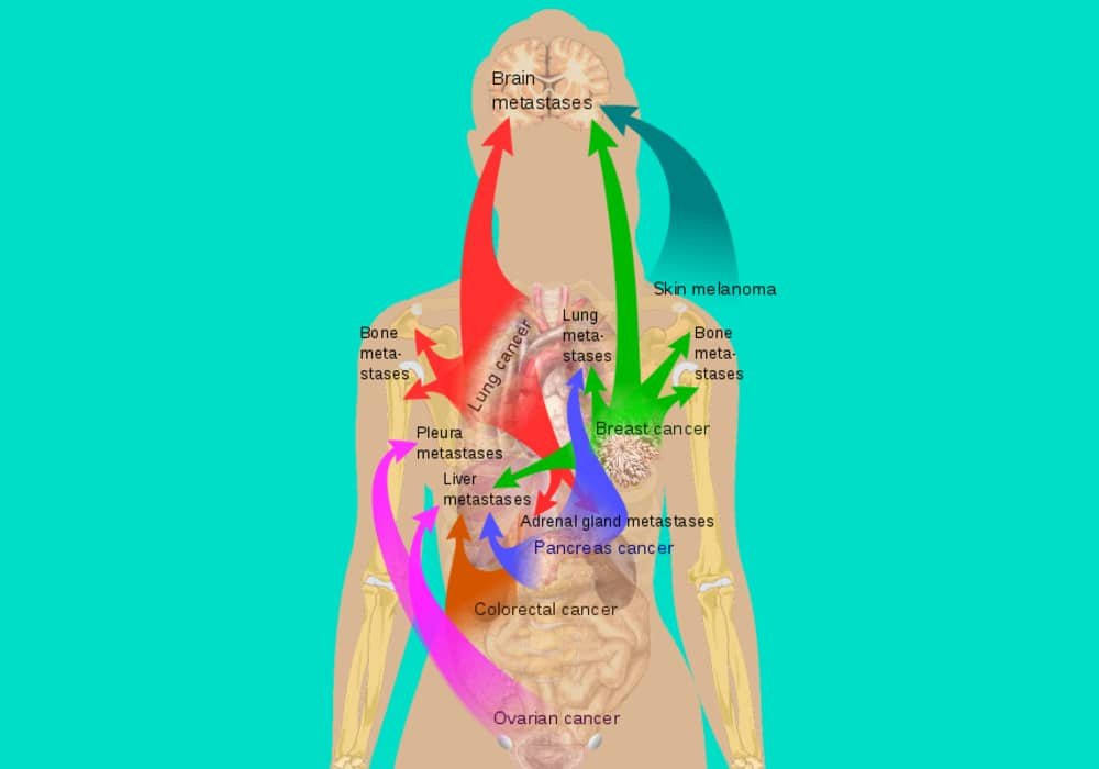 Penanda Tumor - Tumor Marker - Apa Saja Tes Penanda Tumor untuk Kanker? Hal-Hal yang Perlu Anda Ketahui