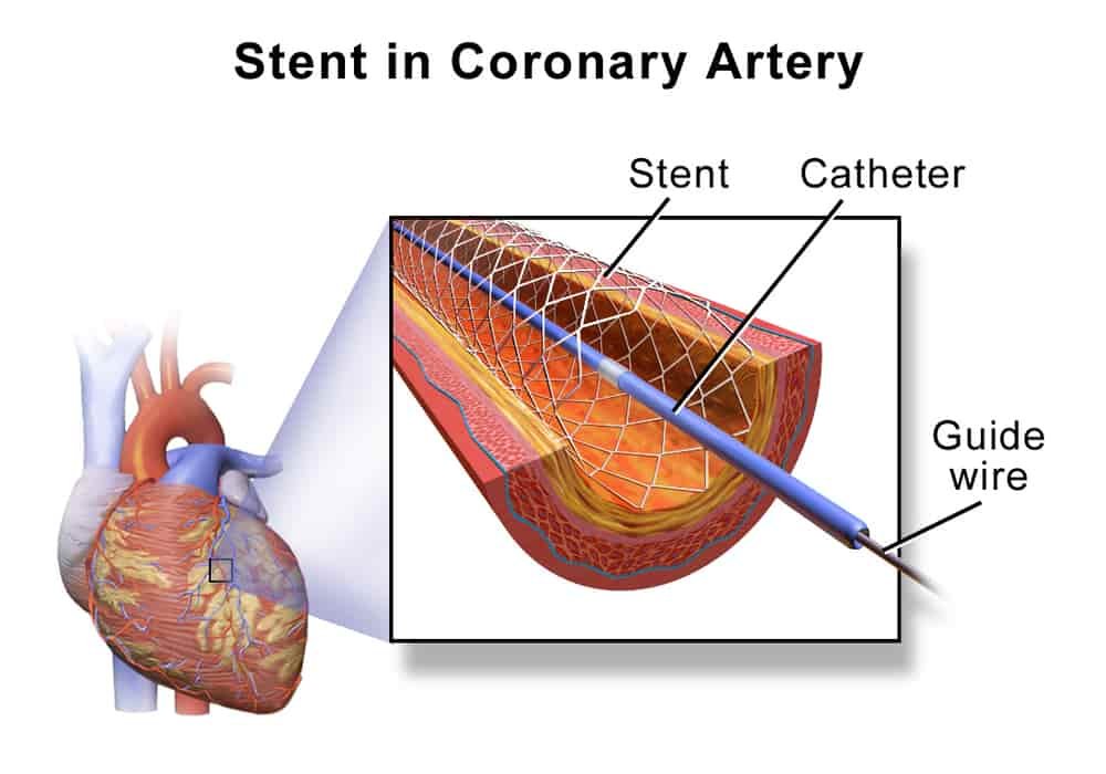 Stent di Arteri Koroner.