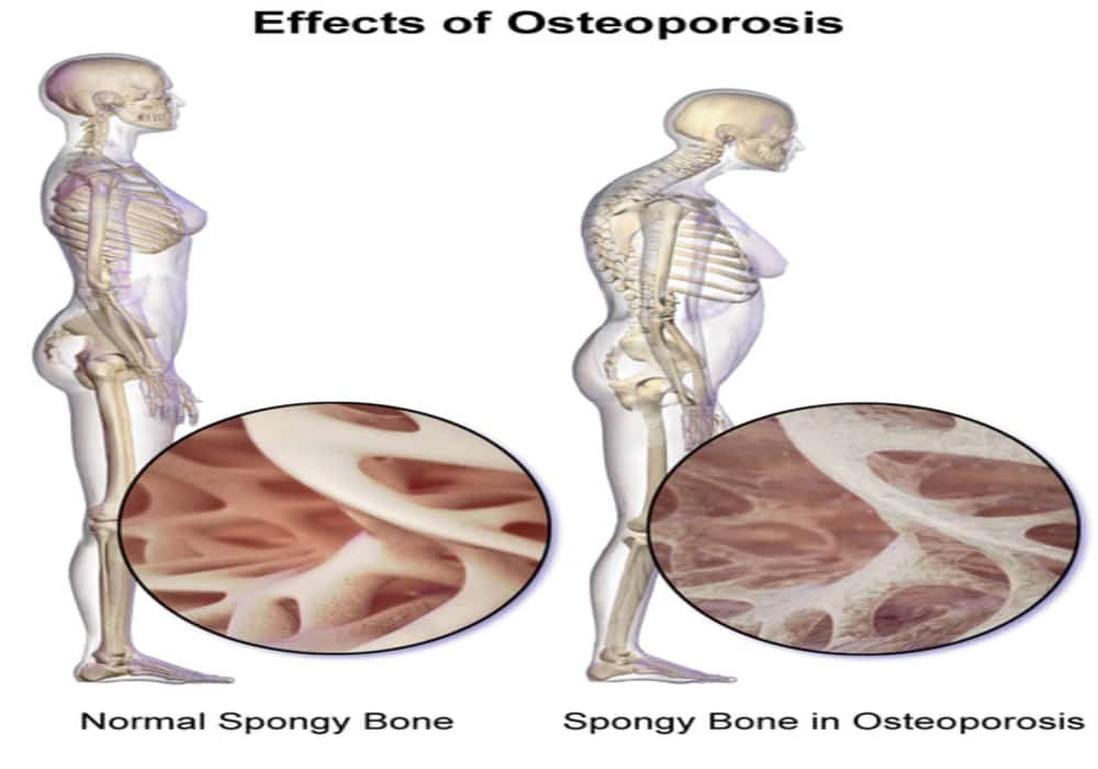 Osteoporosis tulang keropos