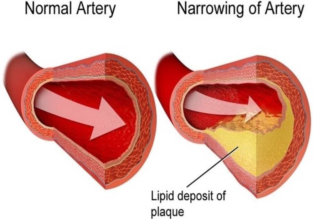 Penyakit jantung aterosklerosis
