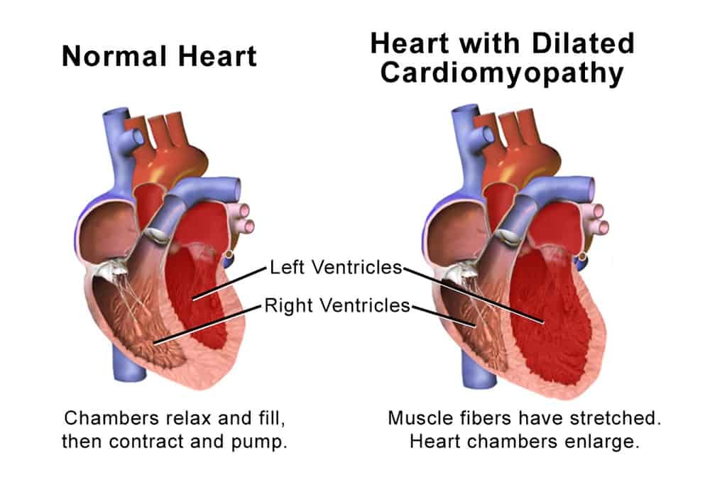 Penyakit otot jantung kardiomiopati