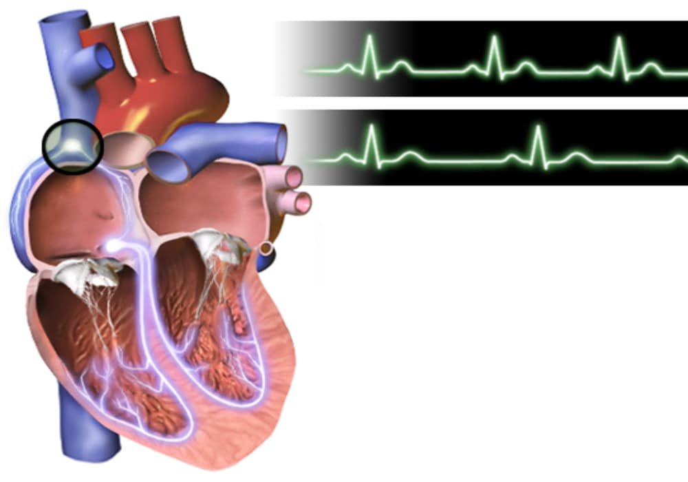 Bradikardia Detak Jantung Lambat | Gejala, Diagnostik, Penyebab dan Pengobatan