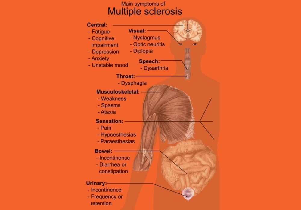 Multiple Sclerosis (Sklerosis multipel) penyakit berpotensi melumpuhkan otak dan saraf sumsum tulang belakang