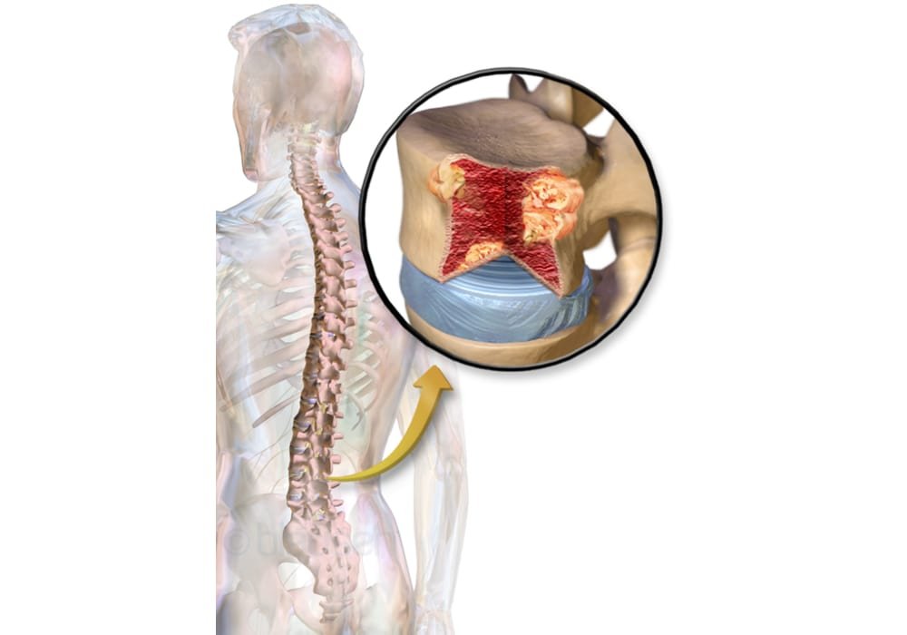 Multiple Myeloma (MM) salah satu jenis kanker sumsum tulang | Gejala, Stadium, Jenis, Diagnosis, Peluang Kehidupan, Perawatan