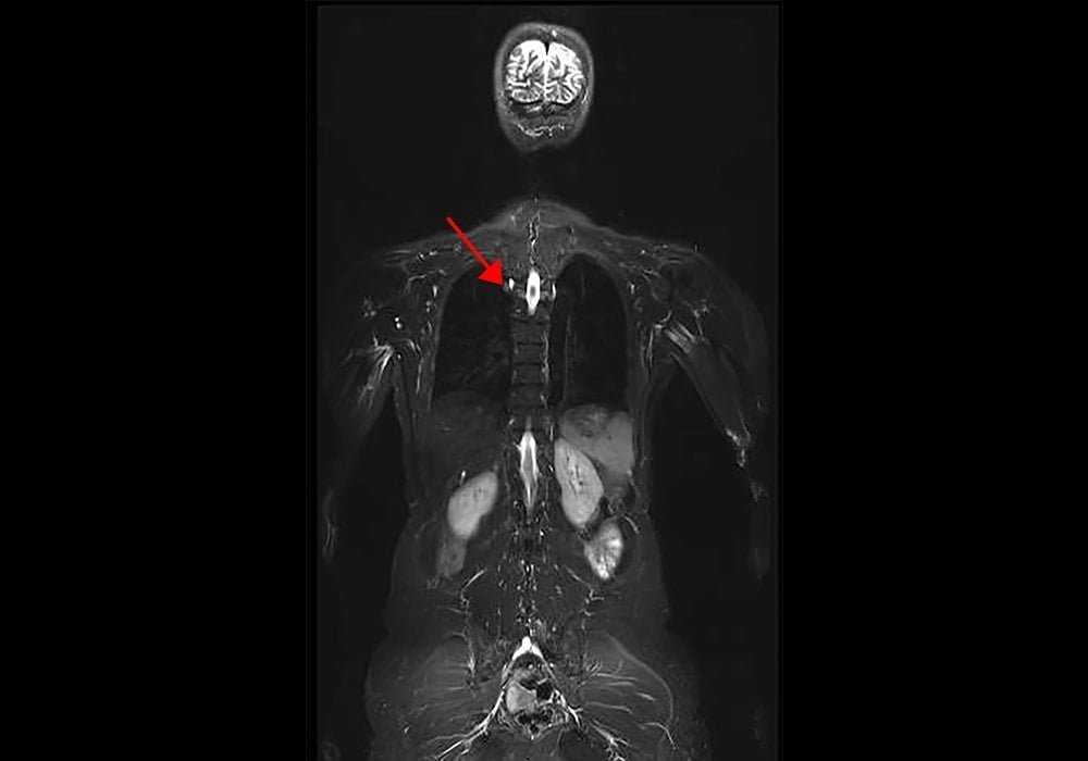 Sindrom Li-Fraumeni (LFS: Li-Fraumeni Syndrome) juga dikenal sebagai sindrom sarkoma, payudara, leukemia, dan kelenjar adrenal