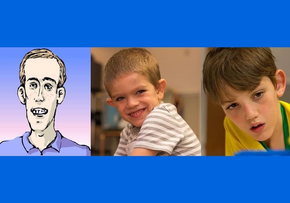 Sindrom Fragile X (FXS) atau Martin Bell Syndrome (MBS) menyebabkan kecacatan intelektual, masalah perilaku dan kelainan fisik