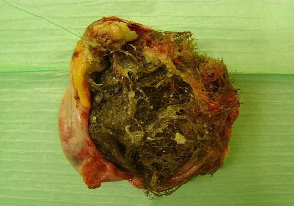 Teratoma ovarium dengan rambut dan gigi