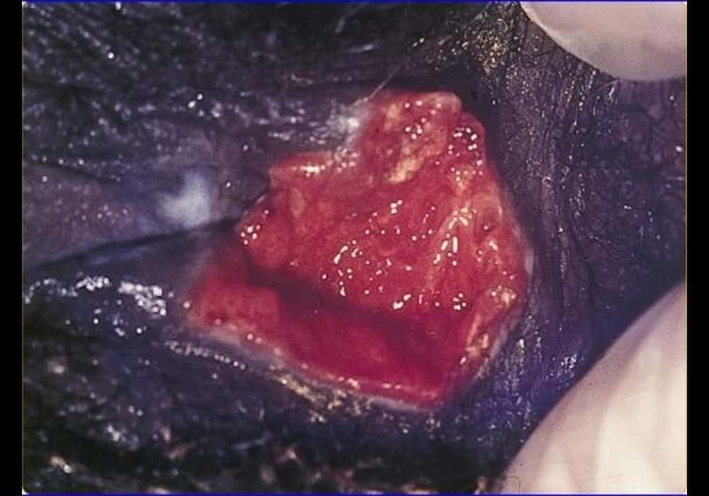 Ulkus berkembang sebagai granuloma inguinale (Donovanosis) di vagina