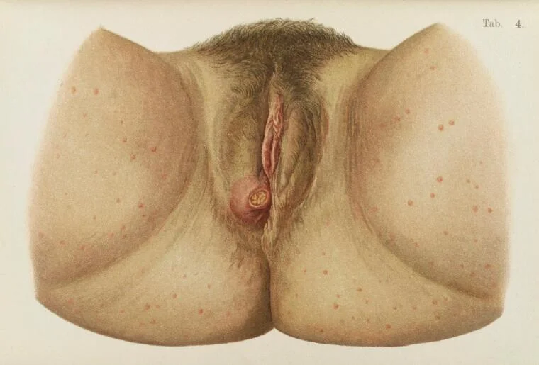 Ilustrasi labia bibir vagina yang terkena sifilis