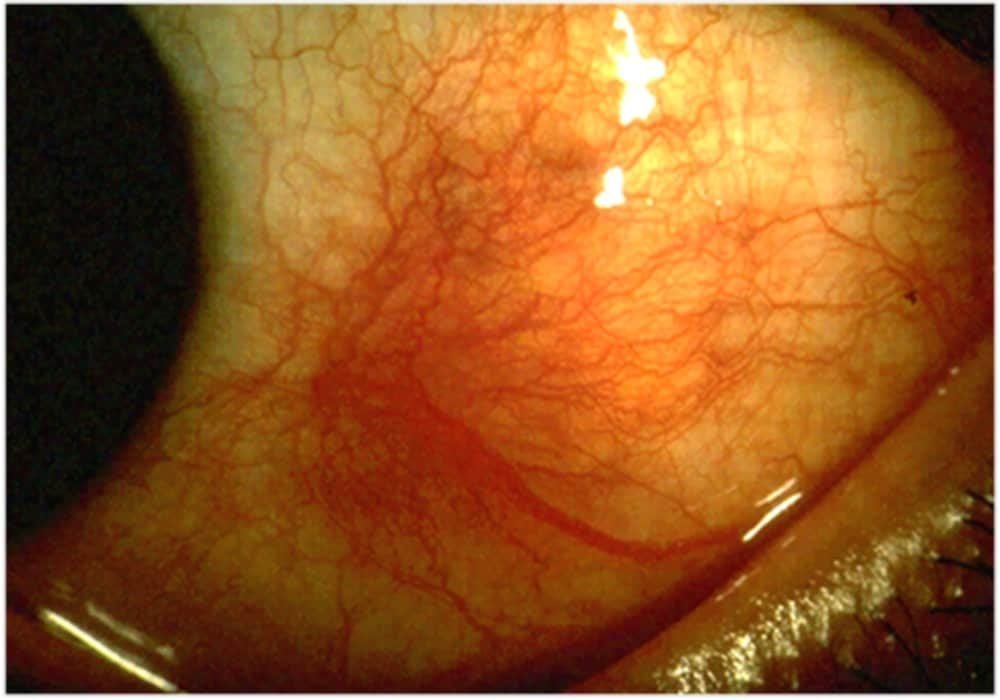 Skleritis (Sclera adalah bagian putih dari bola mata),salah satu penyakit mata