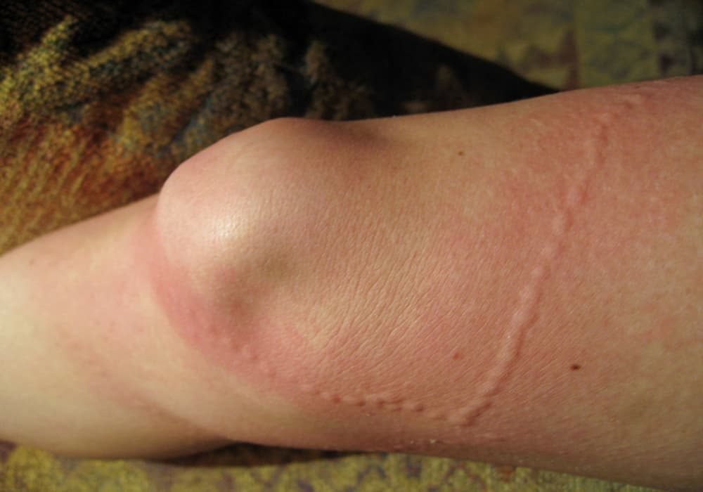 Sengatan ubur-ubur menyebabkan rasa sakit yang intens dan terbakar yang dapat berlangsung selama beberapa jam. Bekas kulit (bekas) dapat berlangsung selama 1 hingga 2 minggu, dan ruam kulit yang gatal dapat muncul 1 hingga 4 minggu setelah sengatan