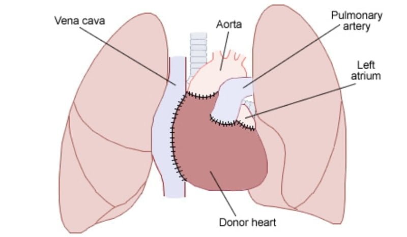 Transplantasi jantung