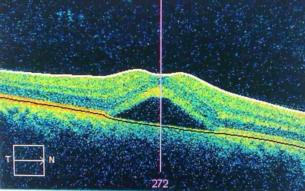 Central serous chorioretinopathy korioretinopati serosa sentral