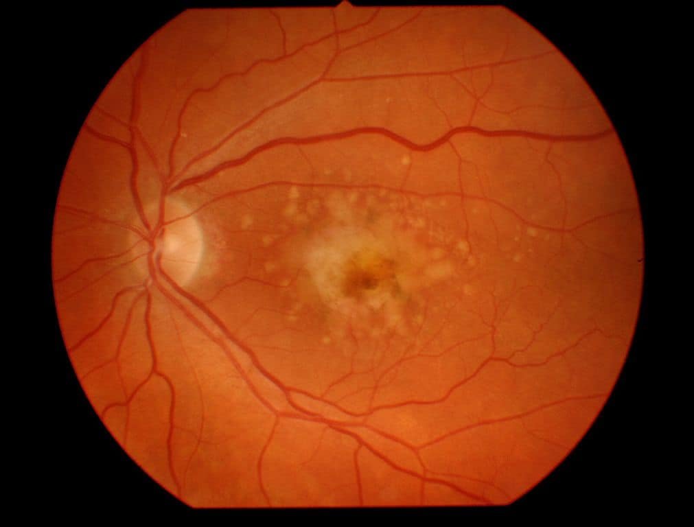 Macular degeneration penyakit retina