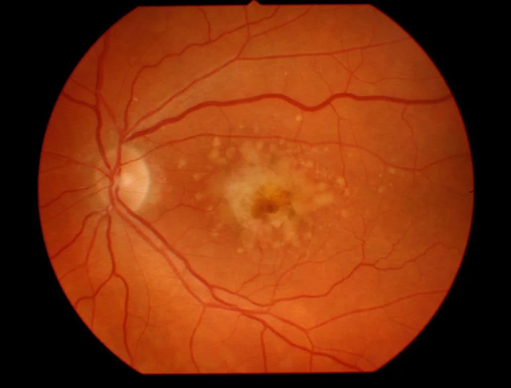 Macular degeneration penyakit retina