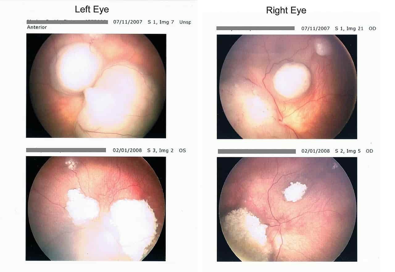 Retinoblastoma kanker retina