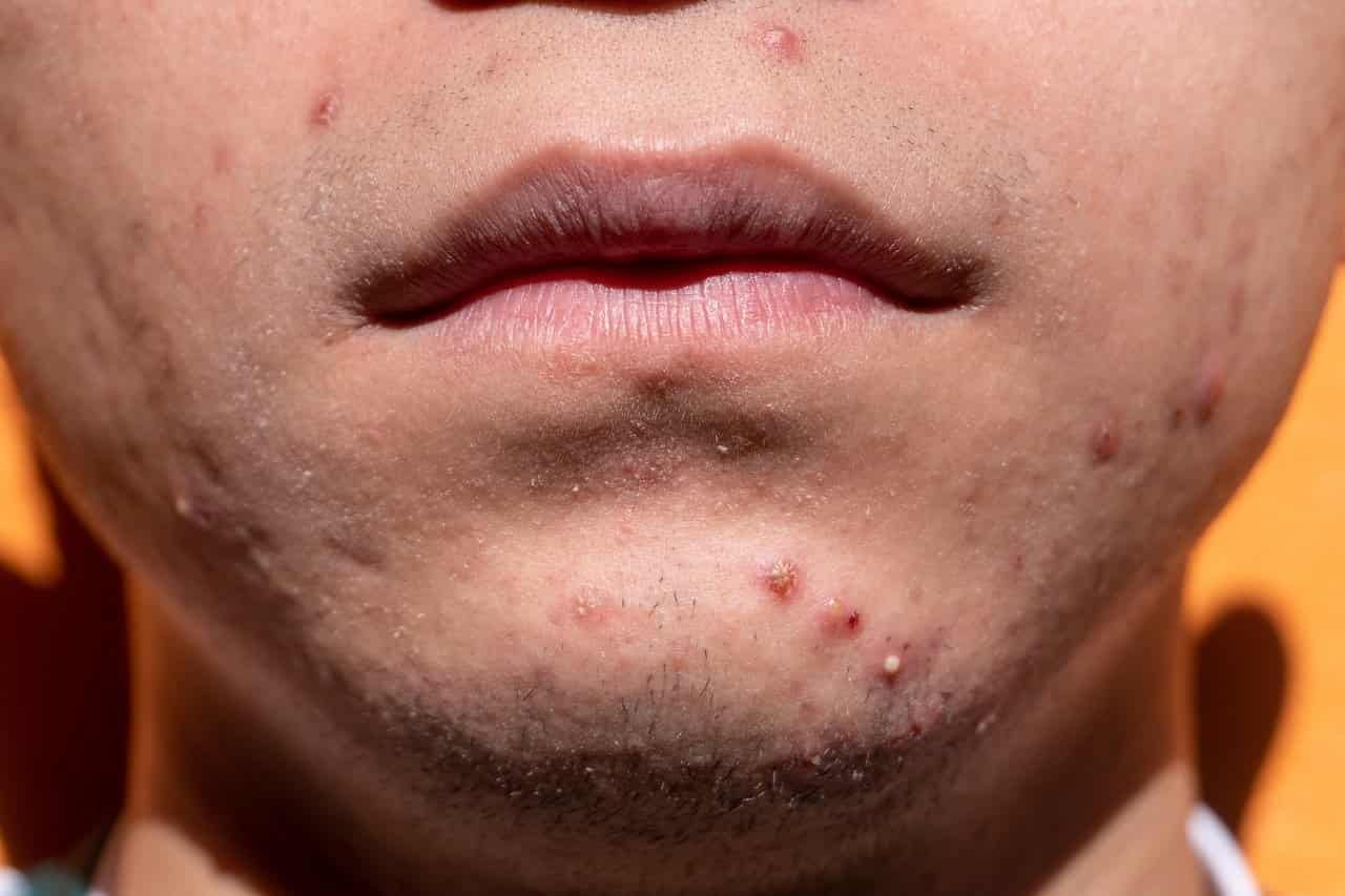 Jerawat (Acne) | Kapan dan bagaimana mengobatinya?