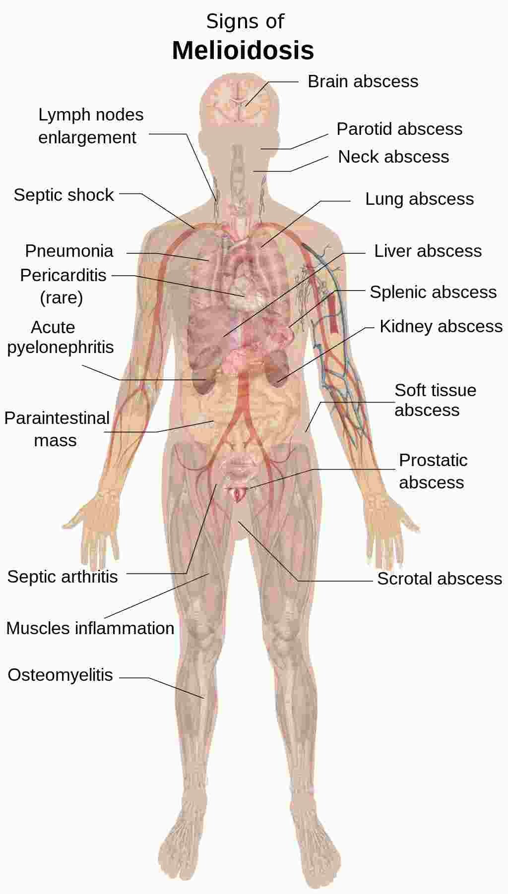 Tanda gejala melioidosis