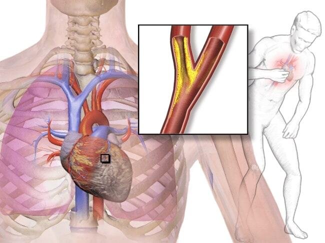 Angina angin duduk nyeri dada